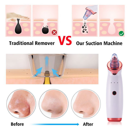 Electric Blackhead Remover